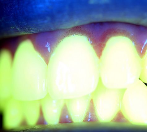 Gums Fluorescence