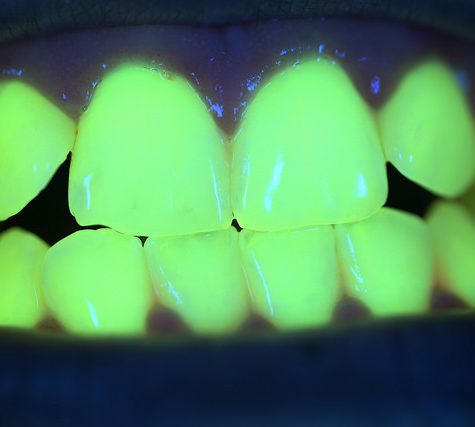 Gums Fluorescence